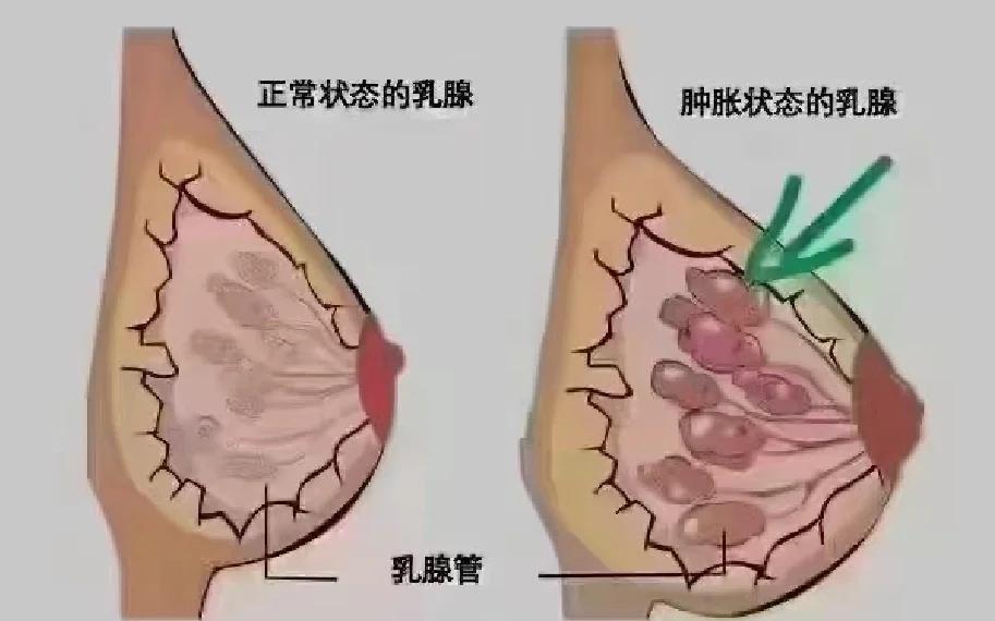 橘皮样乳腺图(橘皮状乳房一定是乳腺癌吗)