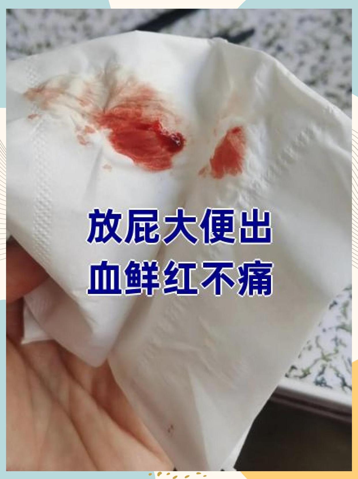 内痔出血图片(内痔大出血有危险吗)