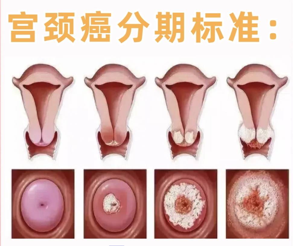 初期宫颈癌图片(初期宫颈癌图片宫颈癌病变)