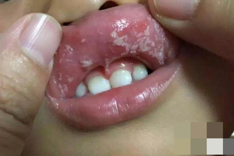婴儿鹅口疮最早期图片(婴儿鹅口疮最早期图片宝宝五岁了)