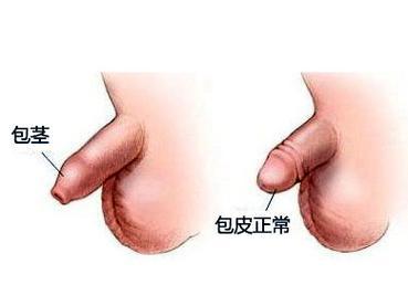 包皮长的图片(包皮图片包皮过长) 包皮长的图片(包皮图片包皮过长)