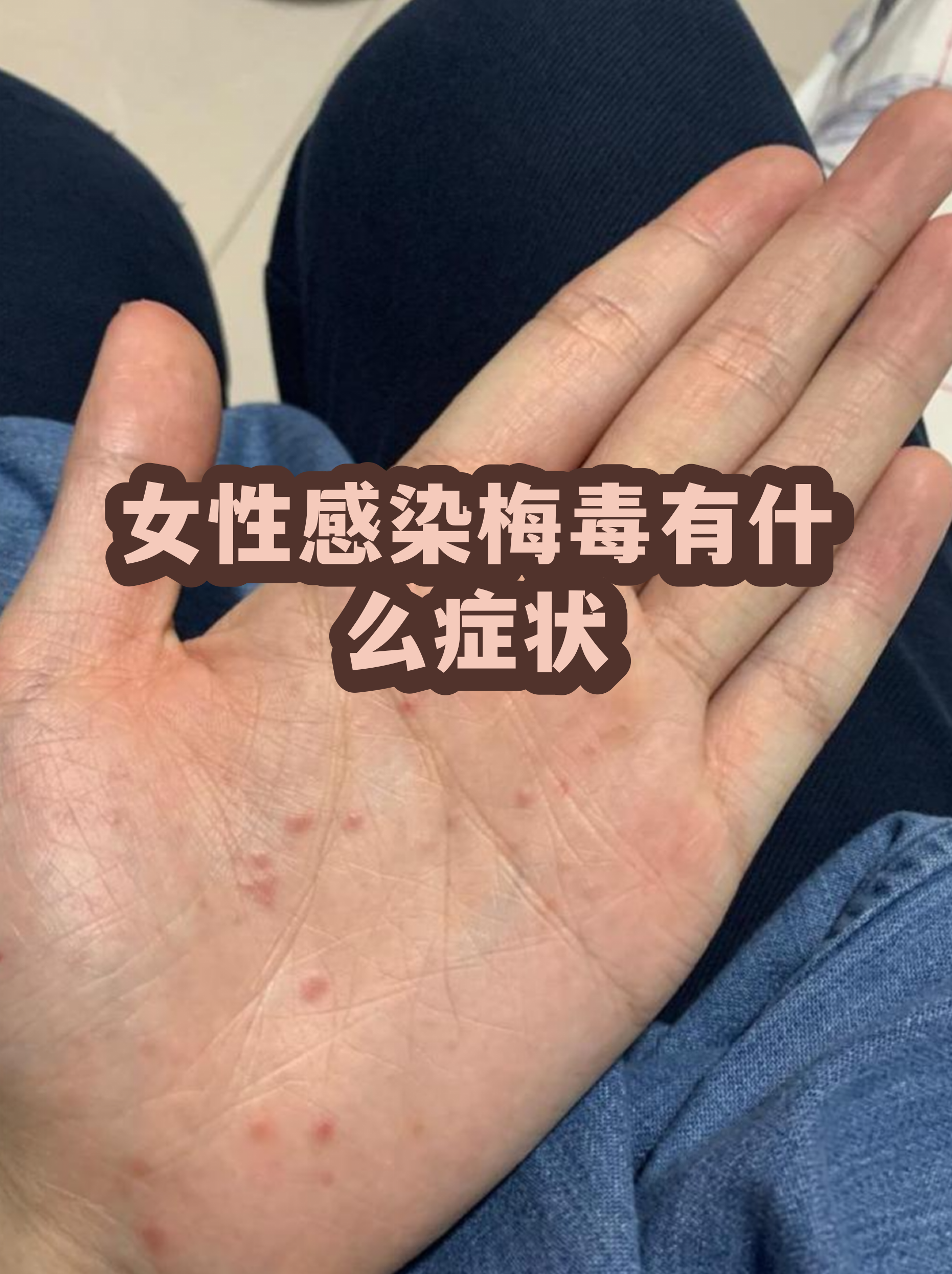 梅毒女性早期症状图片(梅毒女性早期图片大全 初期)