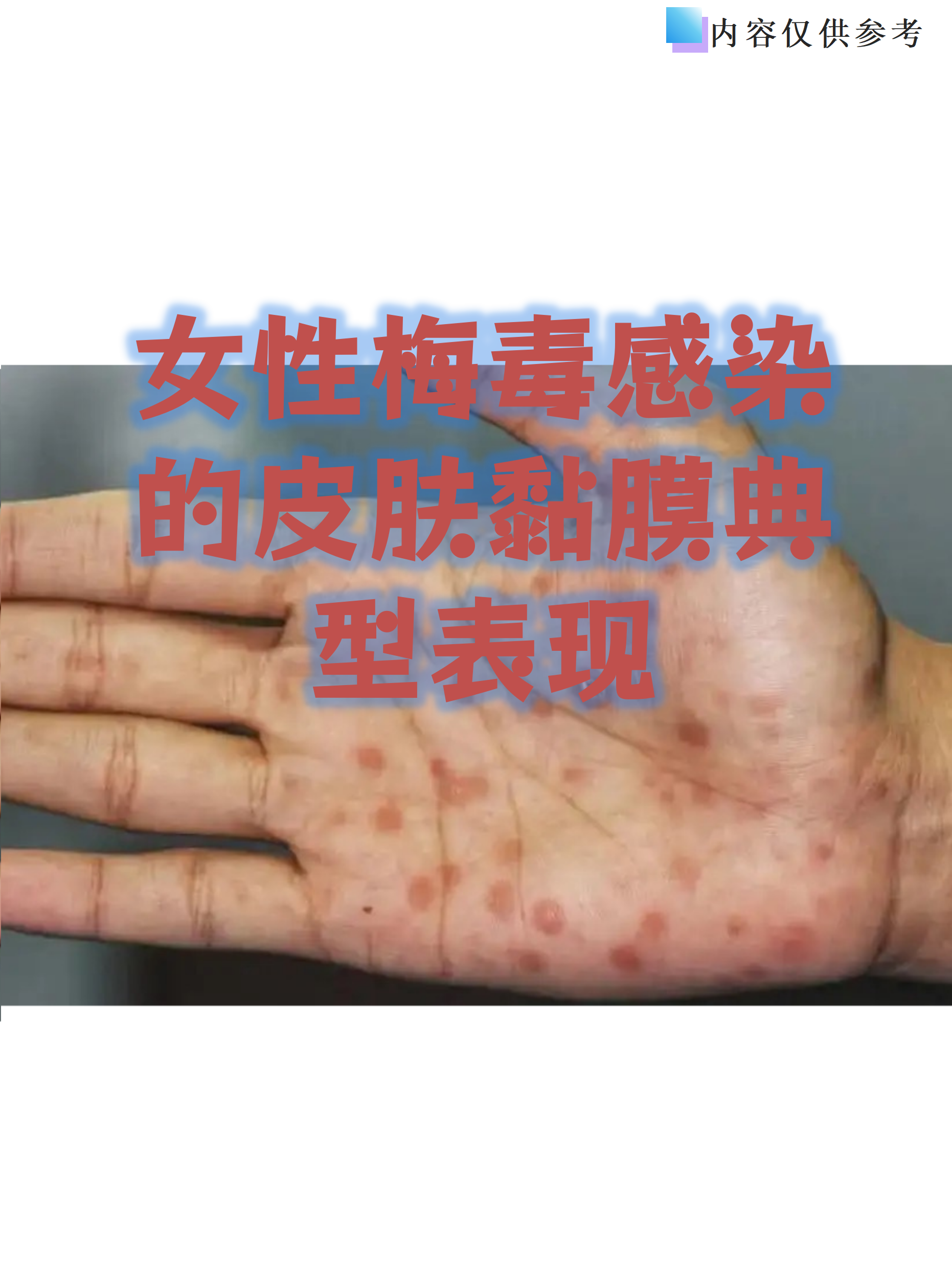 梅毒女性早期症状图片(梅毒女性早期图片大全 初期)