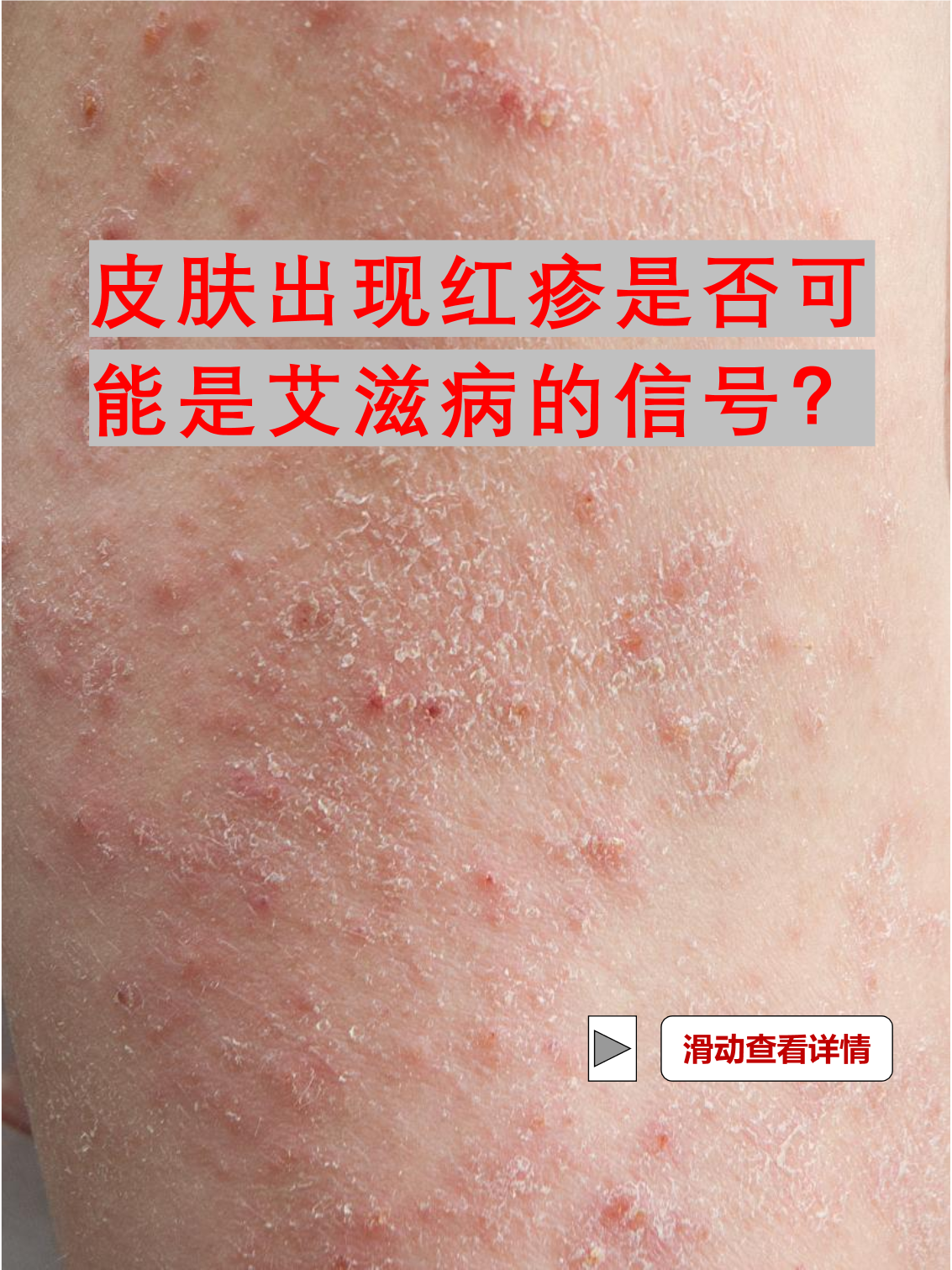 艾滋病胸前红疹图片(艾滋病胸前红疹子和普通疹子区别)