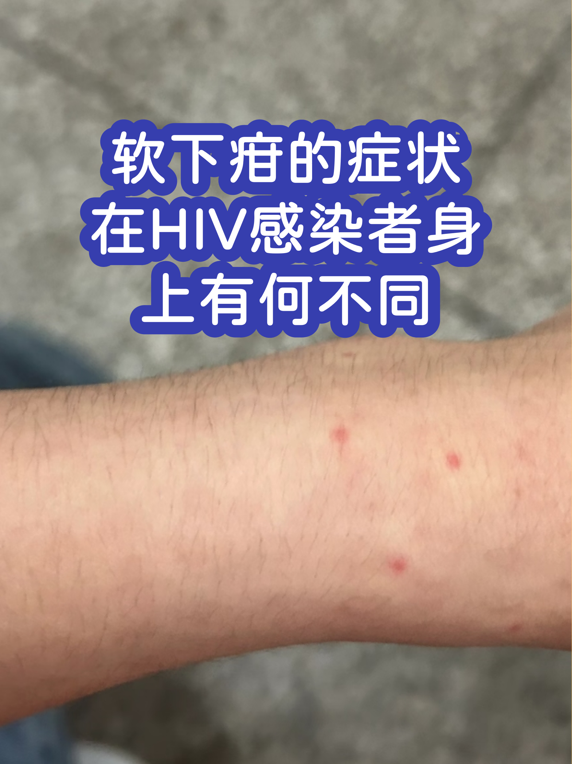 下疳是什么意思(皮肤出现硬下疳是什么意思)