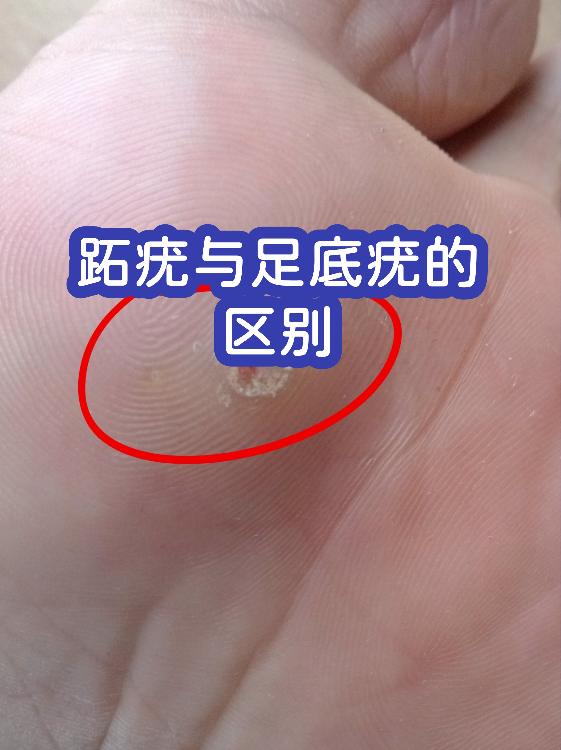 疣和瘊子的区别图片(疣和瘊子的区别图片黑色)
