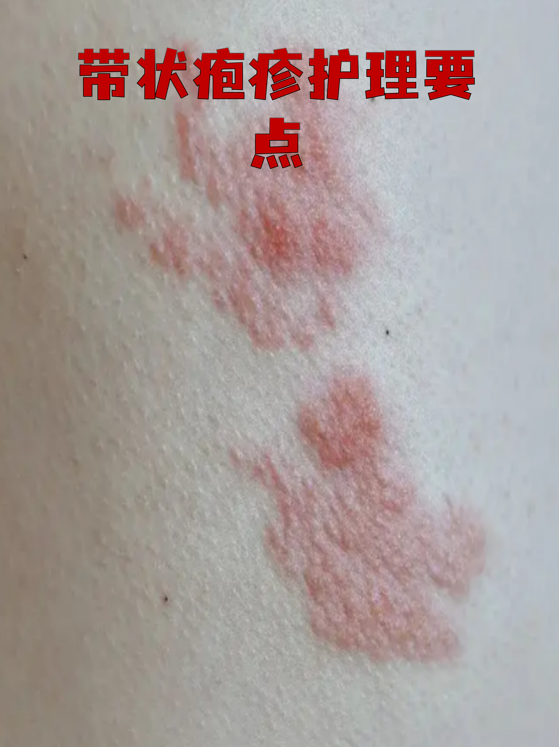 缠腰龙的初期图片(缠身龙一般几天可以好)