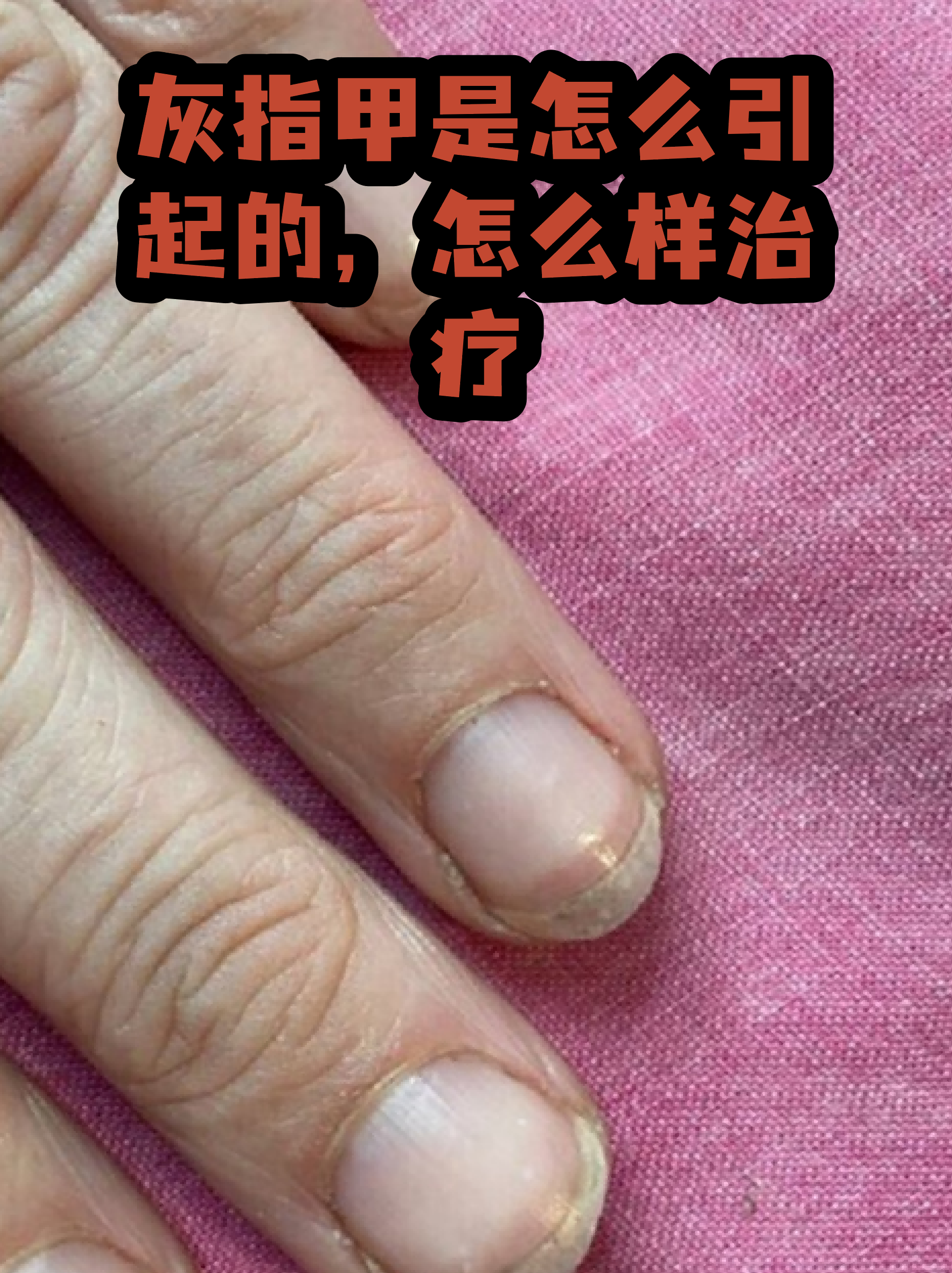 包含灰指甲是什么样的图片看一下的词条