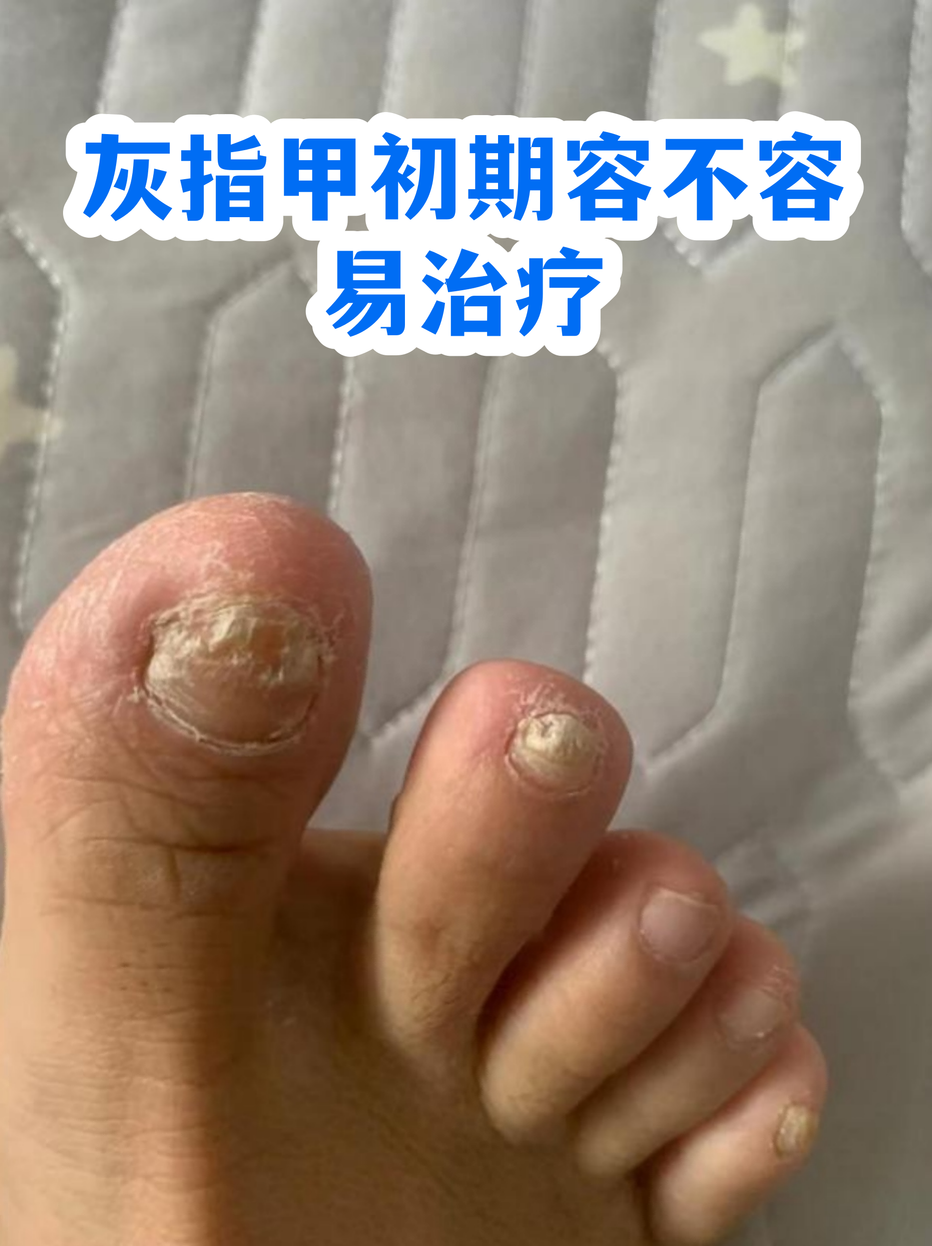 包含灰指甲是什么样的图片看一下的词条
