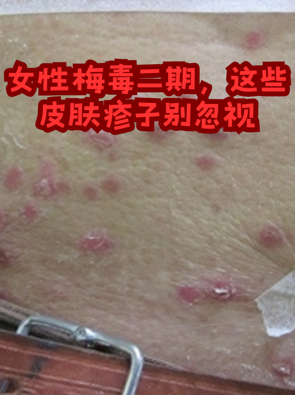 梅毒图片女性(男性梅毒症状图片)