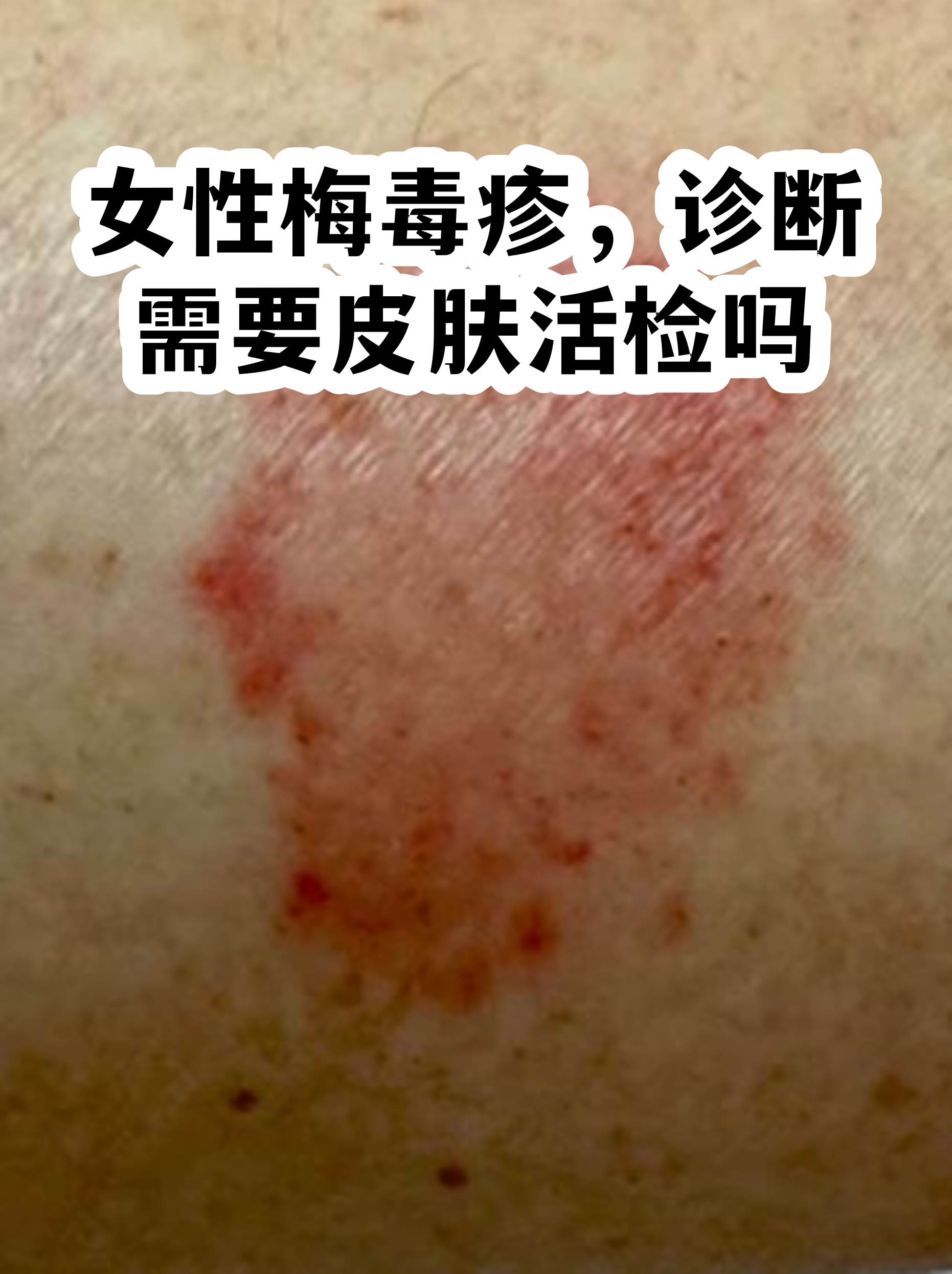 梅毒图片女性(男性梅毒症状图片)