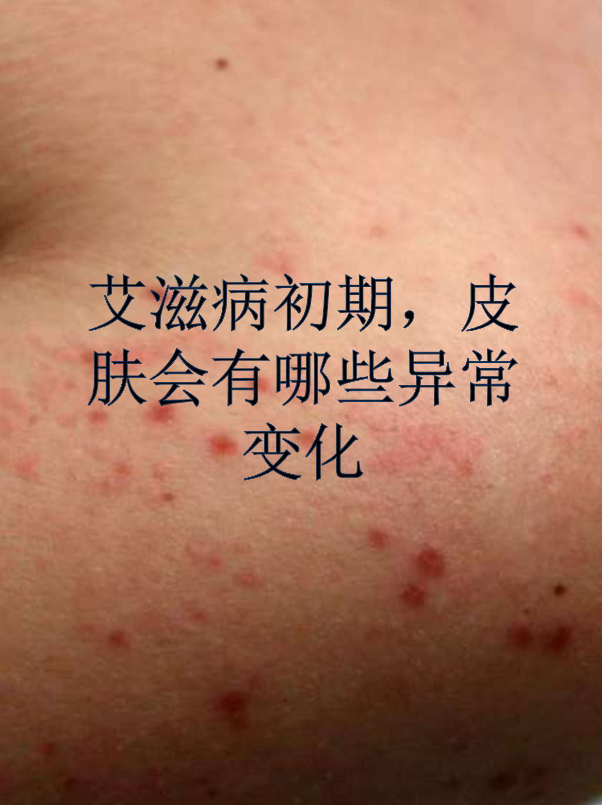 艾滋病起红疹子图片(艾滋病起红疹子图片大全)