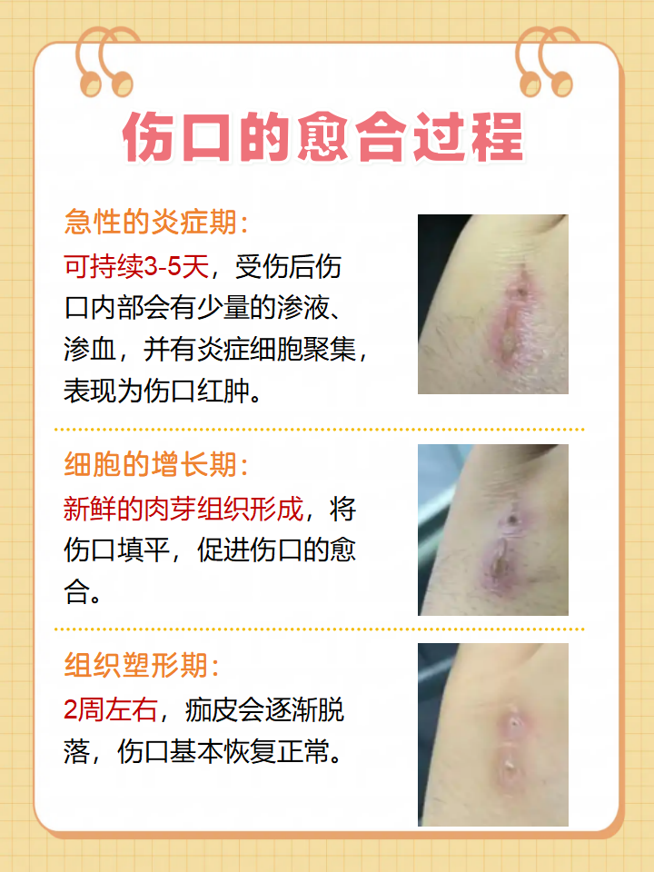 烫伤肉上有白色覆盖物(烫伤肉上有白色覆盖物是不是发炎) 烫伤肉上有白色覆盖物(烫伤肉上有白色覆盖物是不是发炎)