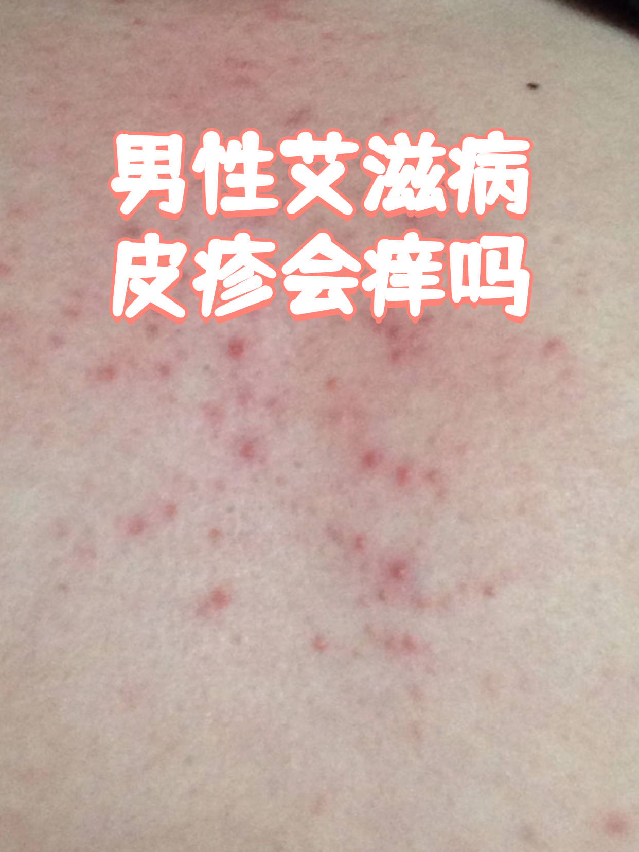 艾滋病皮肤瘙痒图片(艾滋病皮肤痒图 初期)