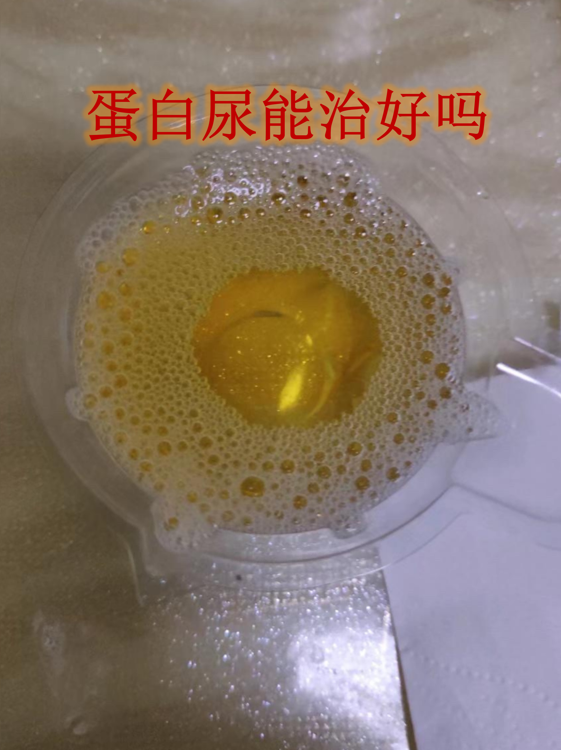 真正的尿蛋白图片(真正的尿蛋白图片 泡沫尿)