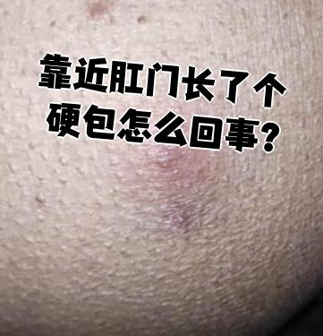 肛门蛲虫病的症状图片(肛门蛲虫病怎么治疗方法)
