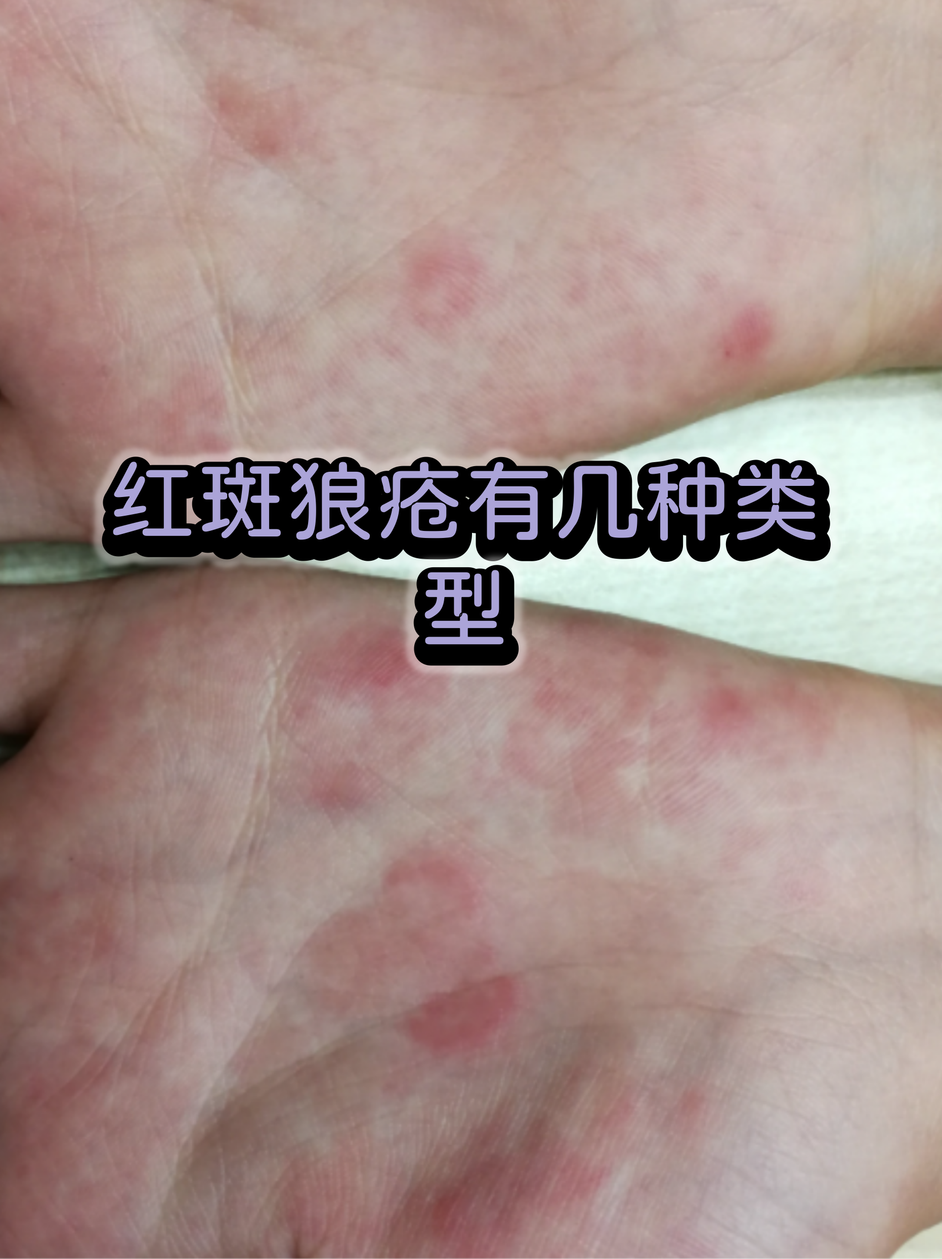 红斑图片(龟 头上红斑图片)