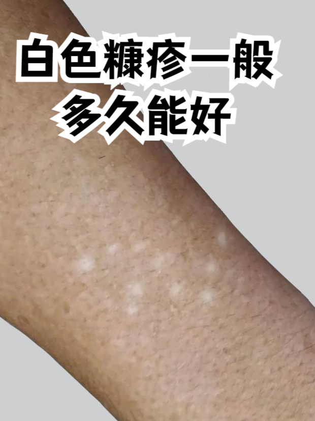 白色糠疹的图片(白色糠疹的图片会扩大吗)