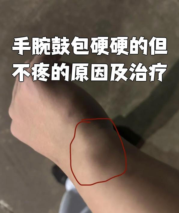 手腕腱鞘囊肿图(手腕腱鞘囊肿图片)