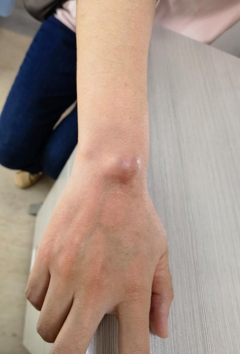 手腕腱鞘囊肿图(手腕腱鞘囊肿图片)