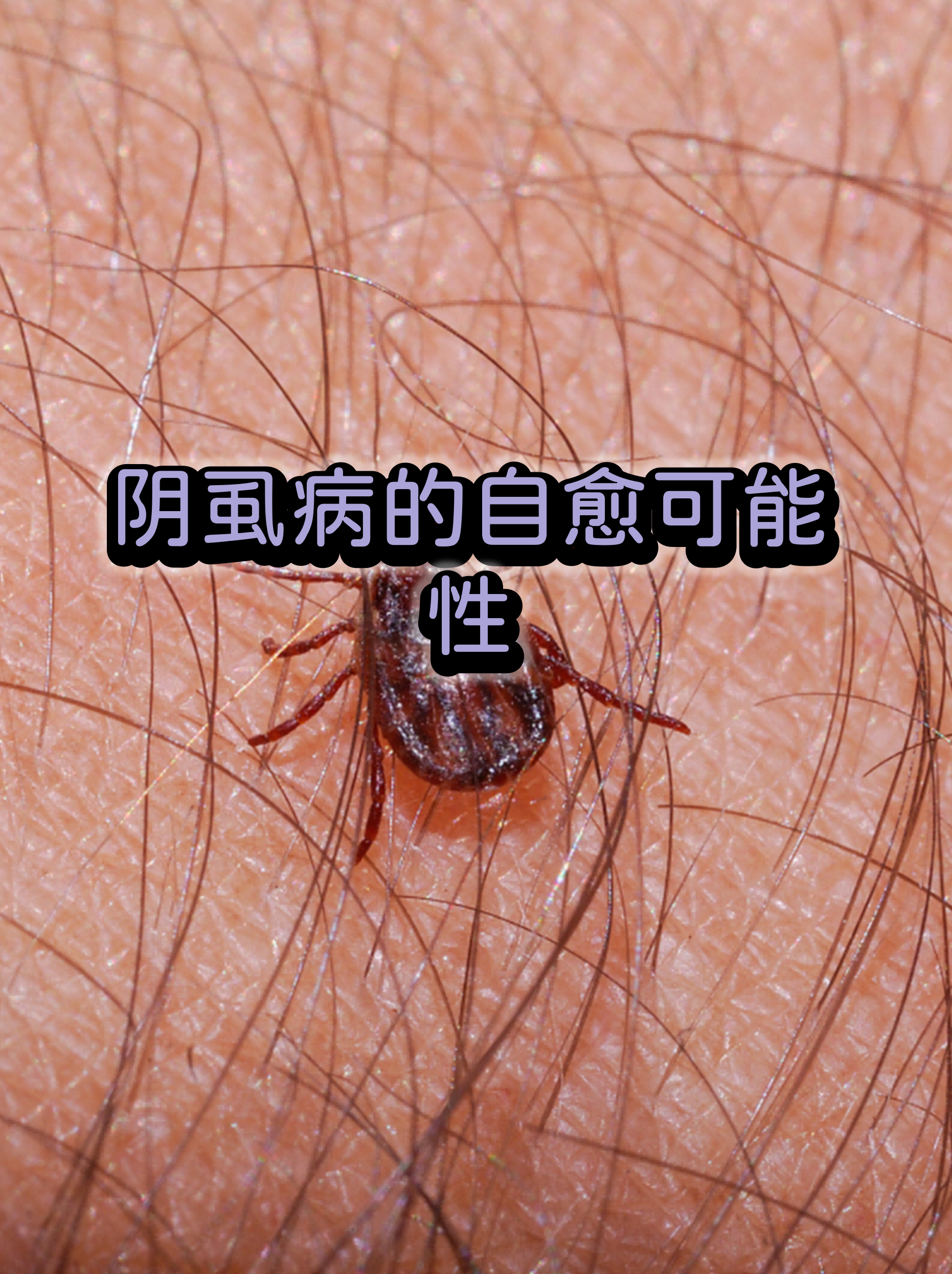 阴虱虫卵图片(阴虱虫卵图片 白色)