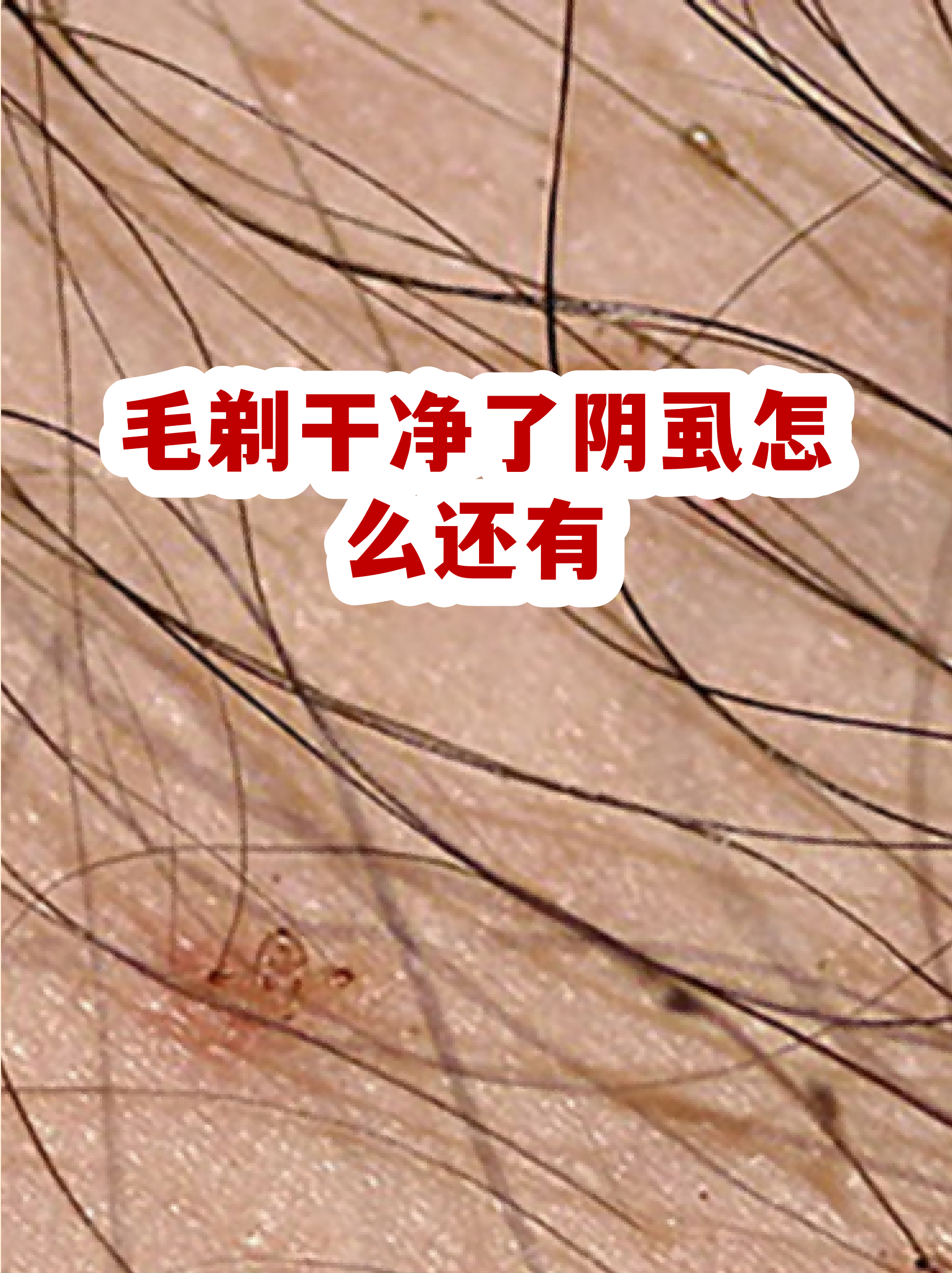 阴虱虫卵图片(阴虱虫卵图片 白色) 阴虱虫卵图片(阴虱虫卵图片 白色)
