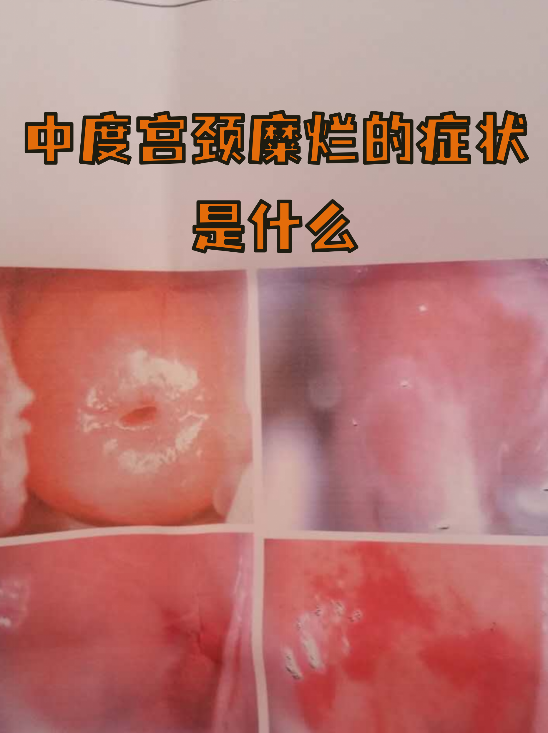宫颈的正常图片(宫颈正常的样子图片)