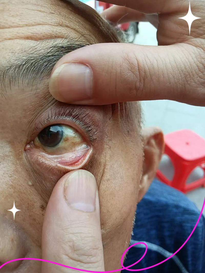 眼瘸症状图片(撅眼最快的治疗方法)