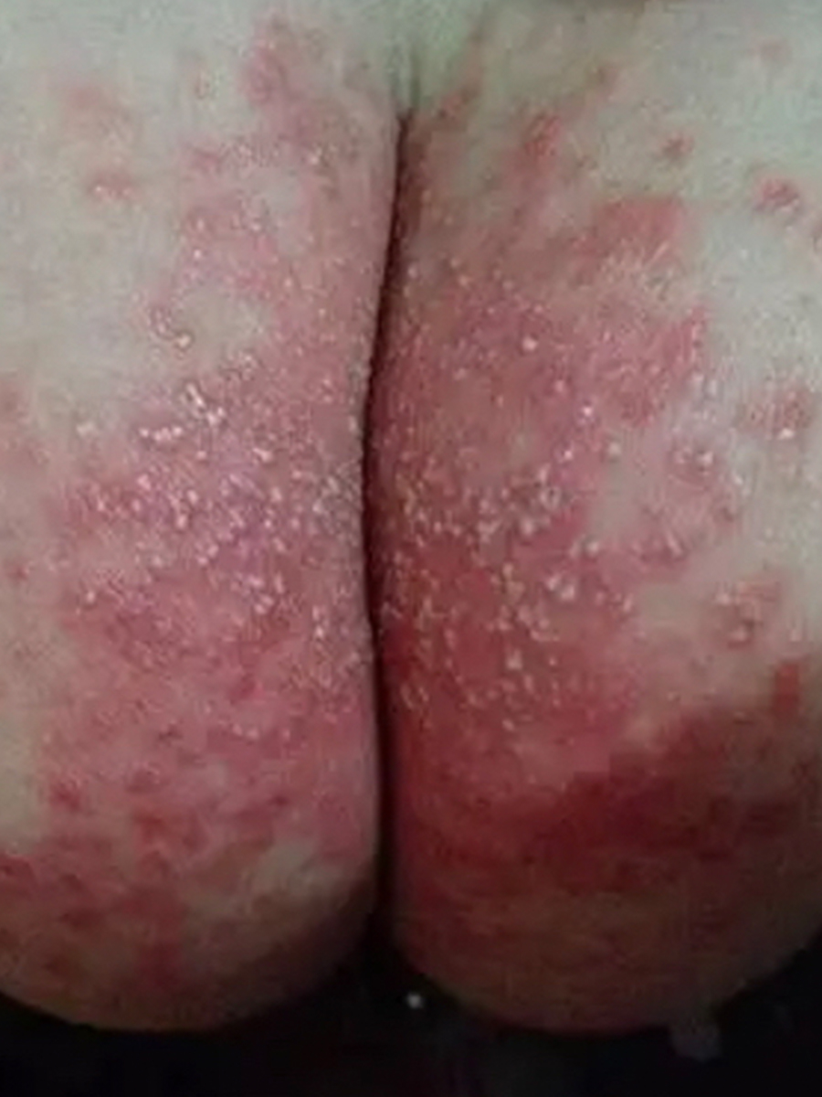 宝宝穿纸尿裤过敏的图片大全(宝宝穿纸尿裤过敏的图片大全真实)