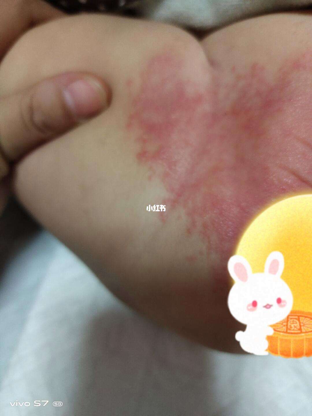 宝宝穿纸尿裤过敏的图片大全(宝宝穿纸尿裤过敏的图片大全真实) 宝宝穿纸尿裤过敏的图片大全(宝宝穿纸尿裤过敏的图片大全真实)