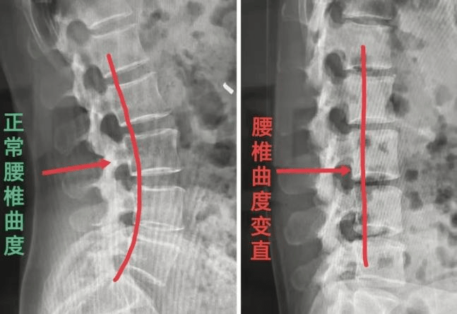 腰椎图片构造图解(颈椎腰椎图片构造图解)