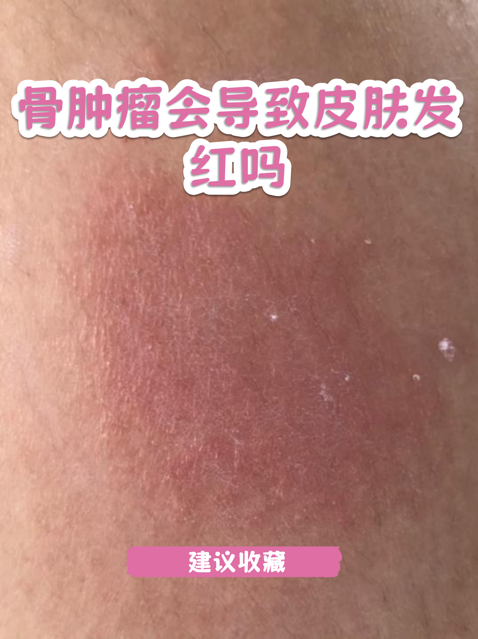 骨癌的早期症状图片(骨癌的早期症状图片介绍癌)