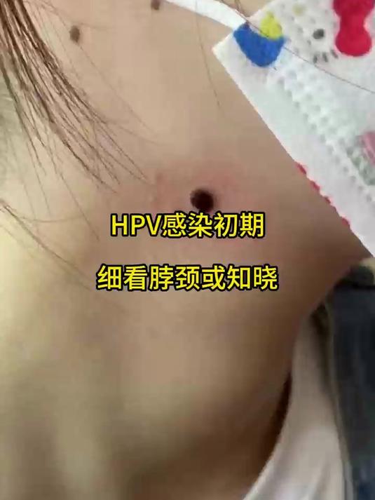 女性hpv初期感染的图片(女性hpv初期感染的图片私处)