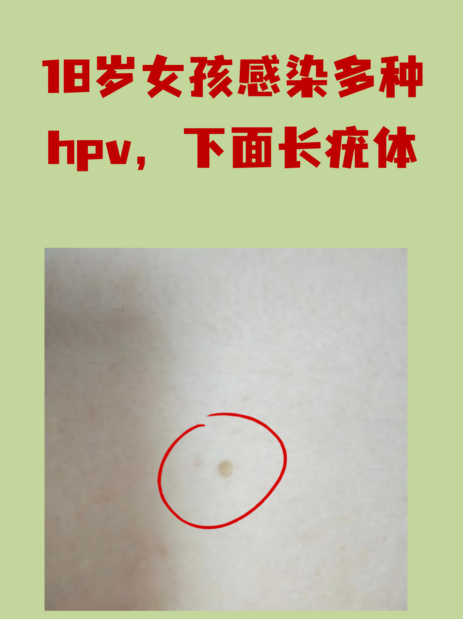 疣体初期图片(疣体一般长什么样子)