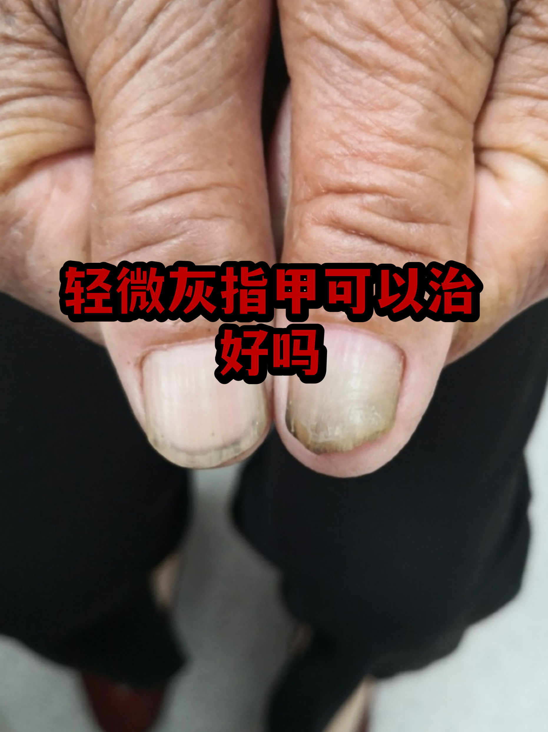 灰指甲的早期症状图(灰指甲早期症状图初始) 灰指甲的早期症状图(灰指甲早期症状图初始)