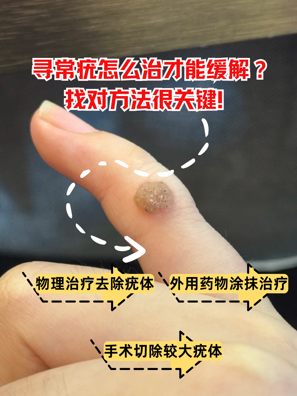疣的种类及图片及治疗方法(私处疣的种类及图片及治疗方法)