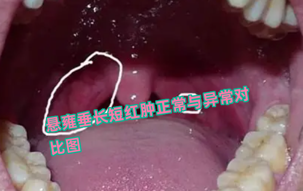 咽炎图片和正常图片对比(咽炎的症状图片,咽炎图片大全)