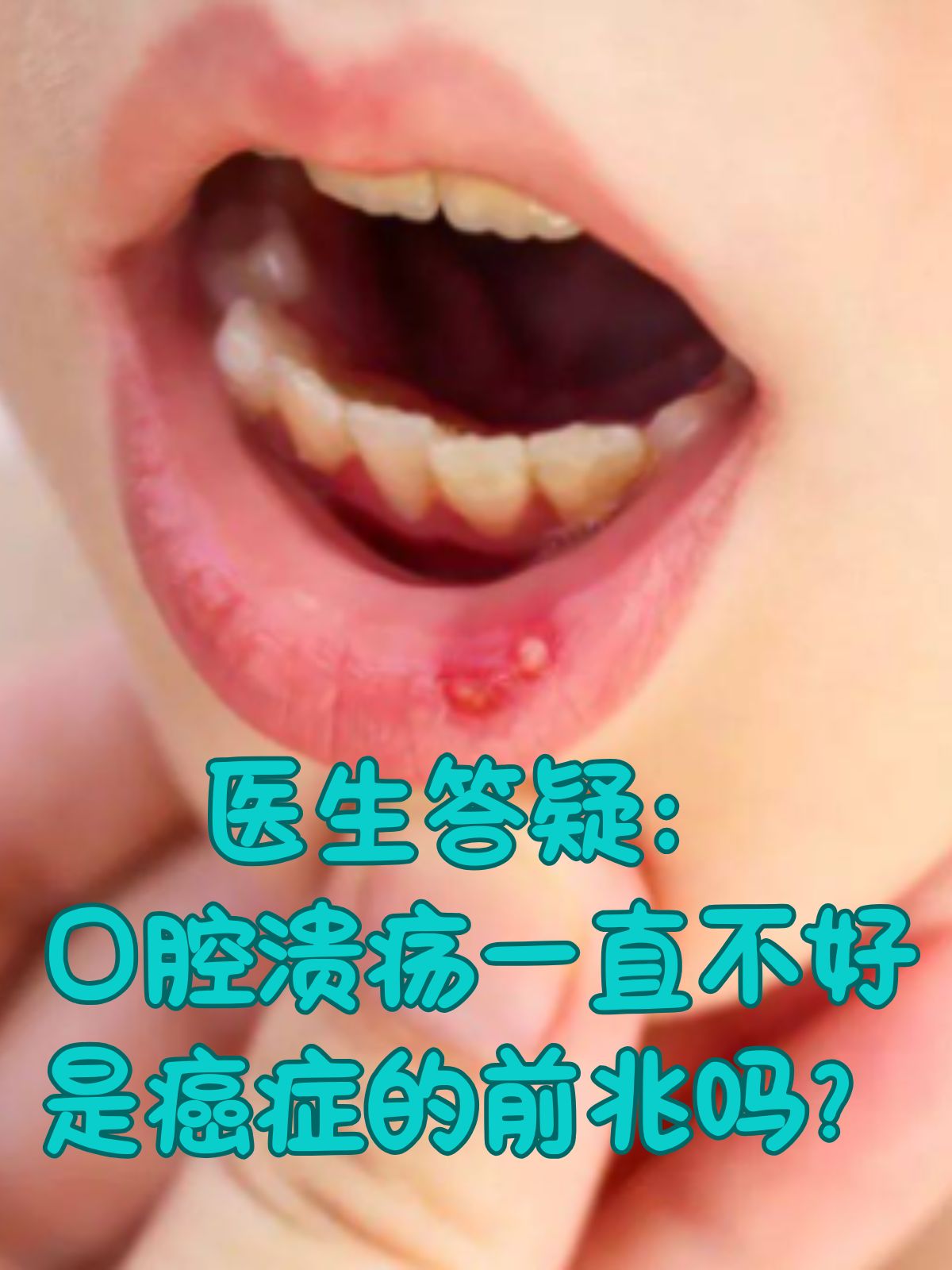 口腔溃疡发病原因图片(口腔溃疡发病原因 知乎)