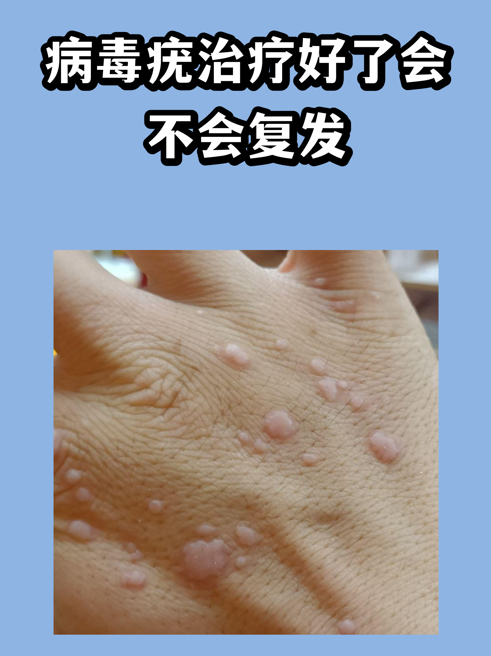 几种常见疣体图片(各种疣的图片 新闻)