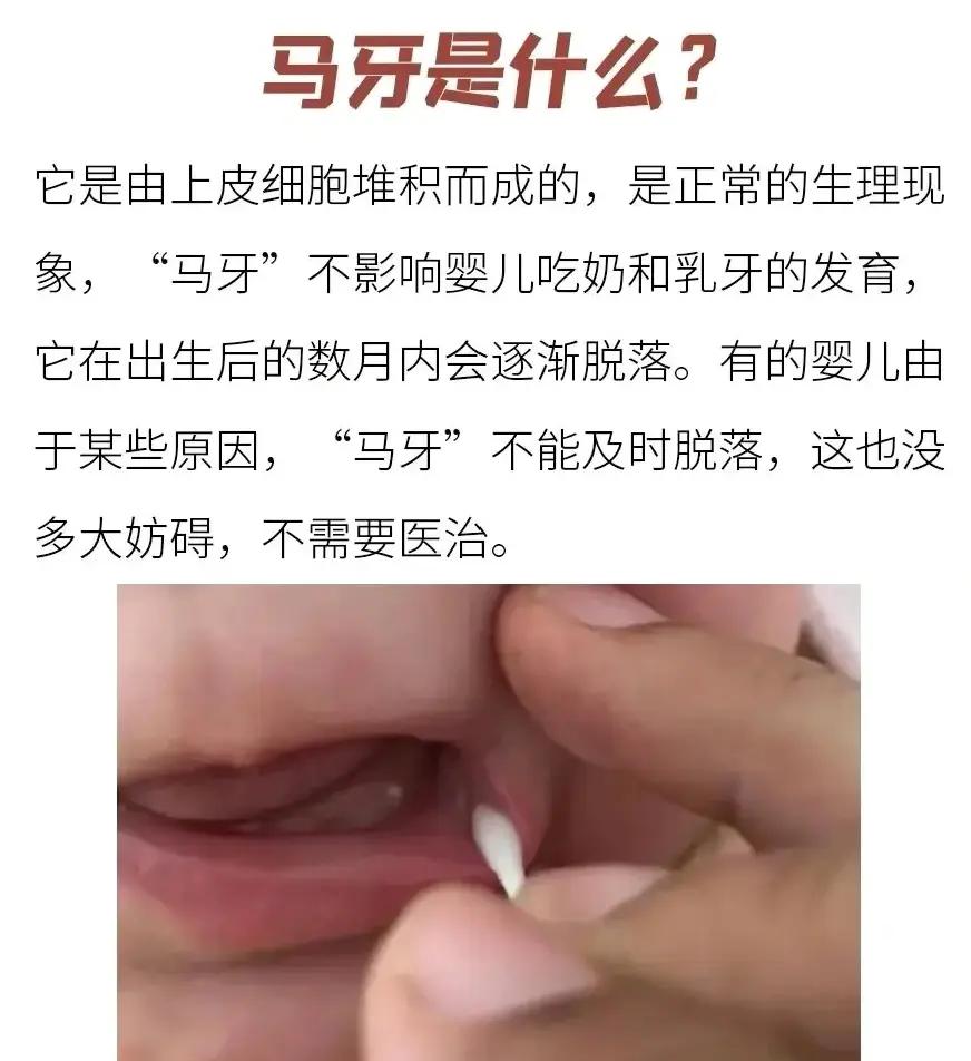 新生儿马牙图片大全(鹅口疮和马牙的辨别图)