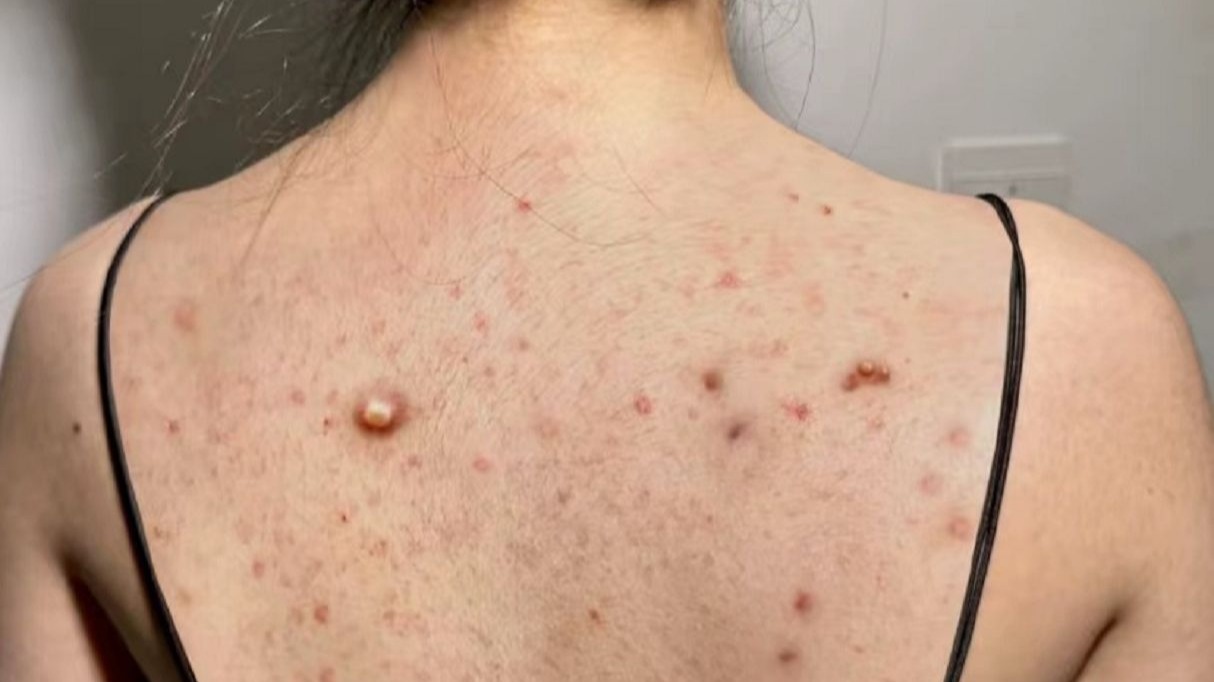 什么是螨虫型痘痘图片(脸上螨虫痘痘怎么去除最有效) 什么是螨虫型痘痘图片(脸上螨虫痘痘怎么去除最有效)