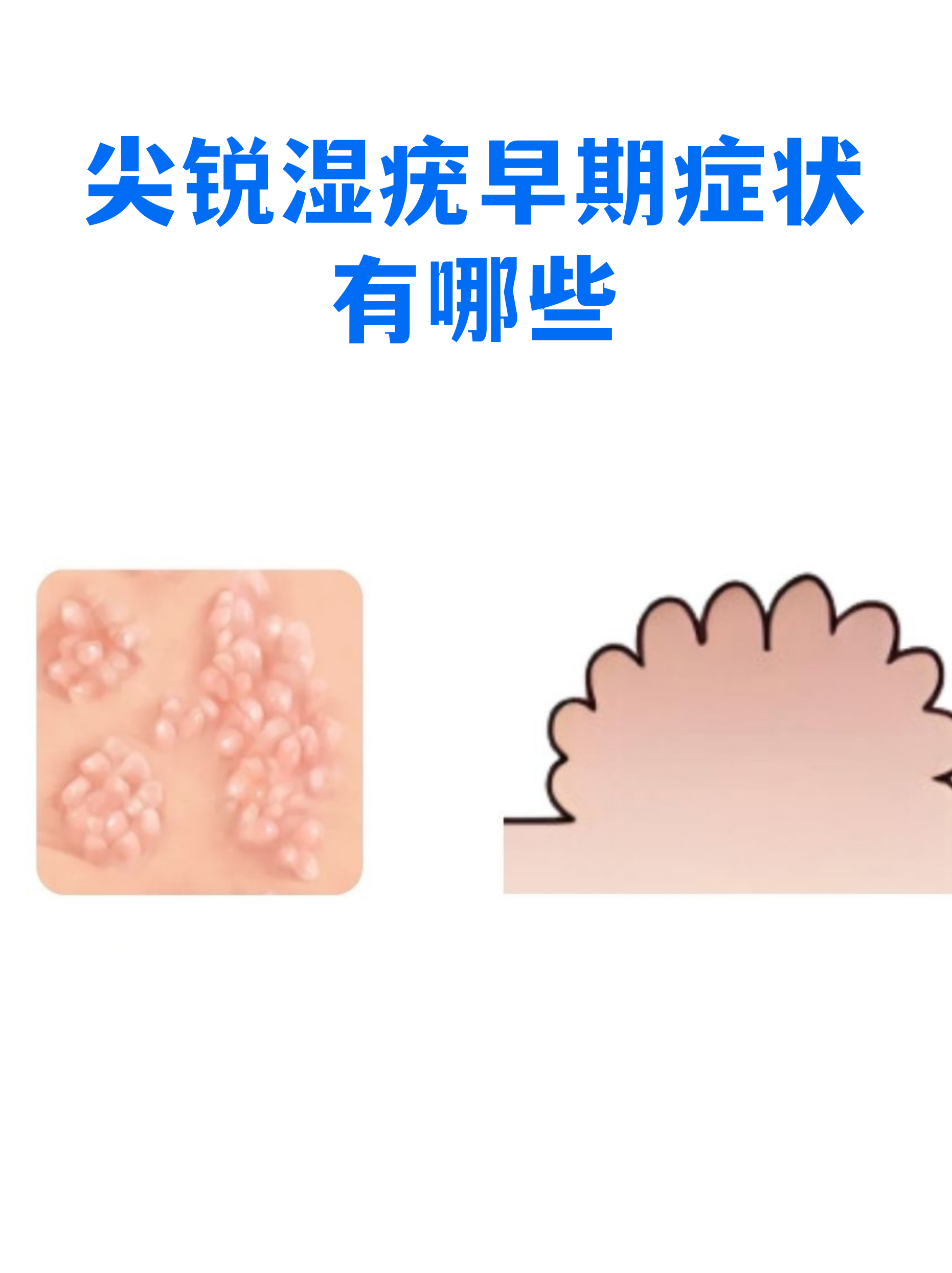 男性菜花状疣高清图片(龟的头上长菜花怎么治疗)