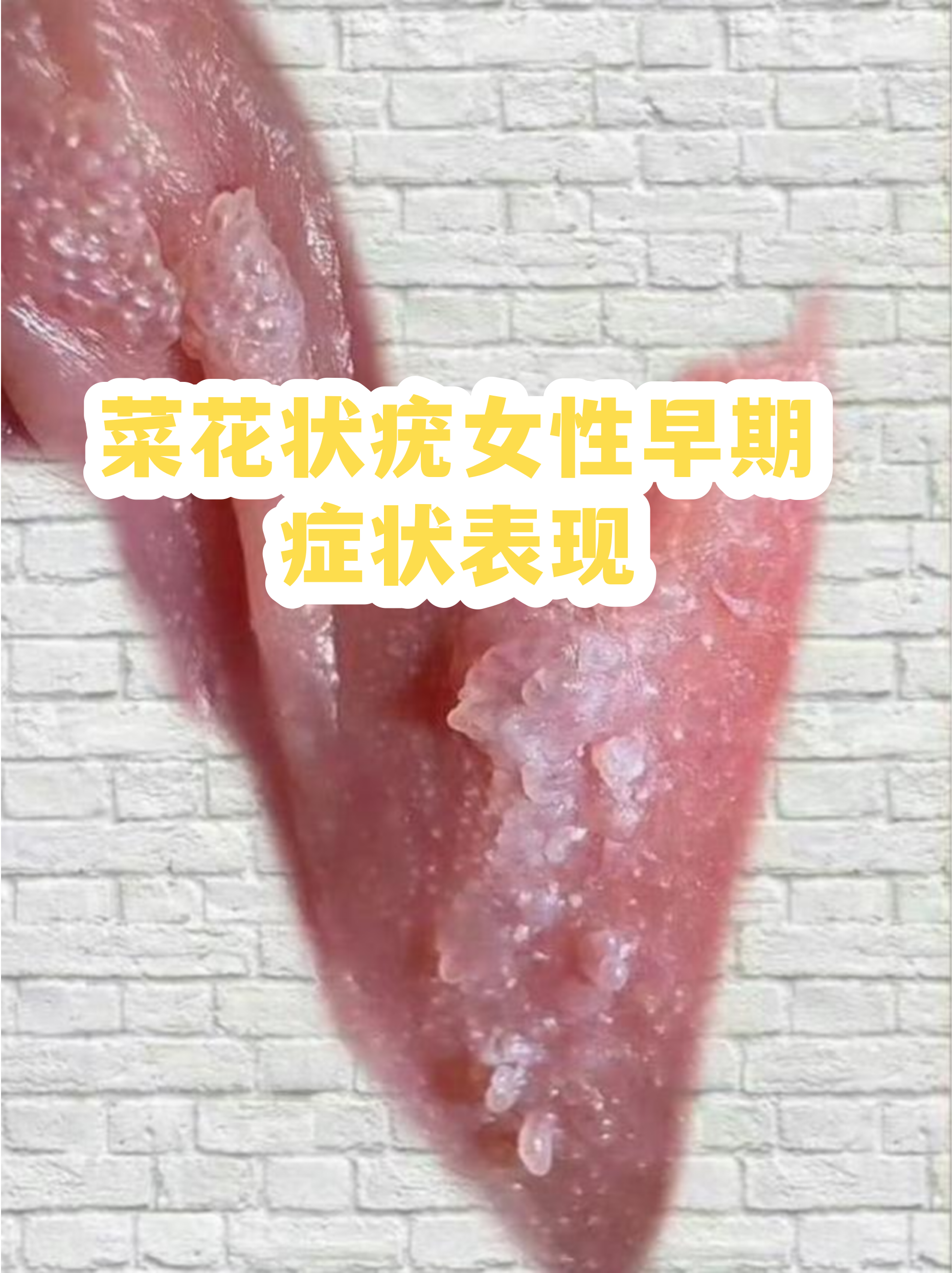 男性菜花状疣高清图片(龟的头上长菜花怎么治疗)