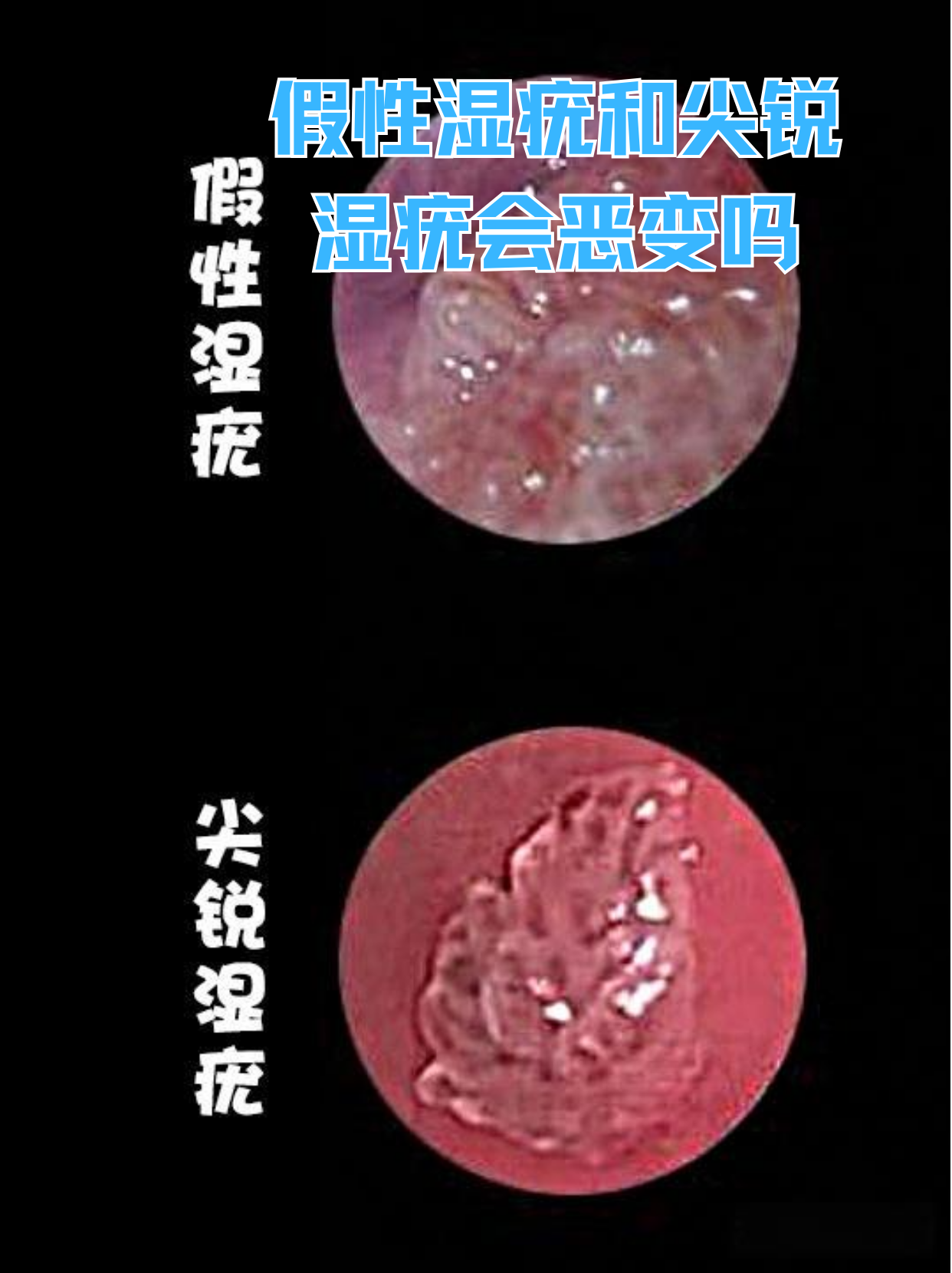 假性湿庞早期图片区别(假性湿庞会发展成真的吗)