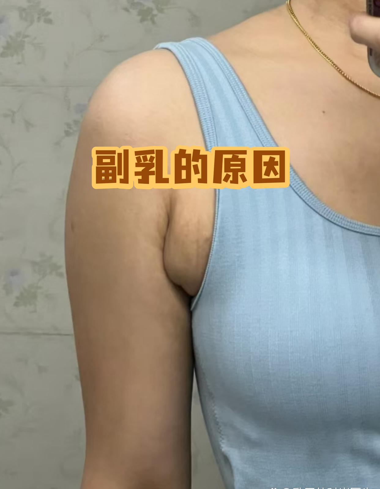 腋窝副乳什么样子(腋窝副乳长什么样子)