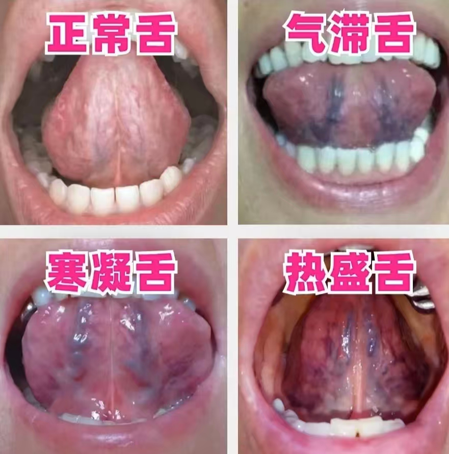 正常舌底部高清图片(口部感染hpv的症状)