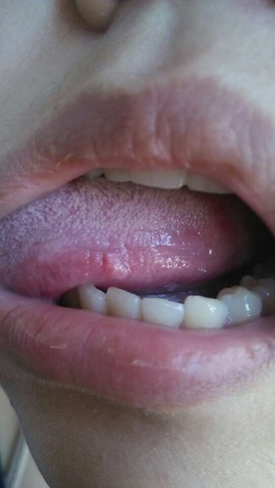 尾巴骨上面有个肉鼓包图片(男性尾巴骨有一个凸起的东西)