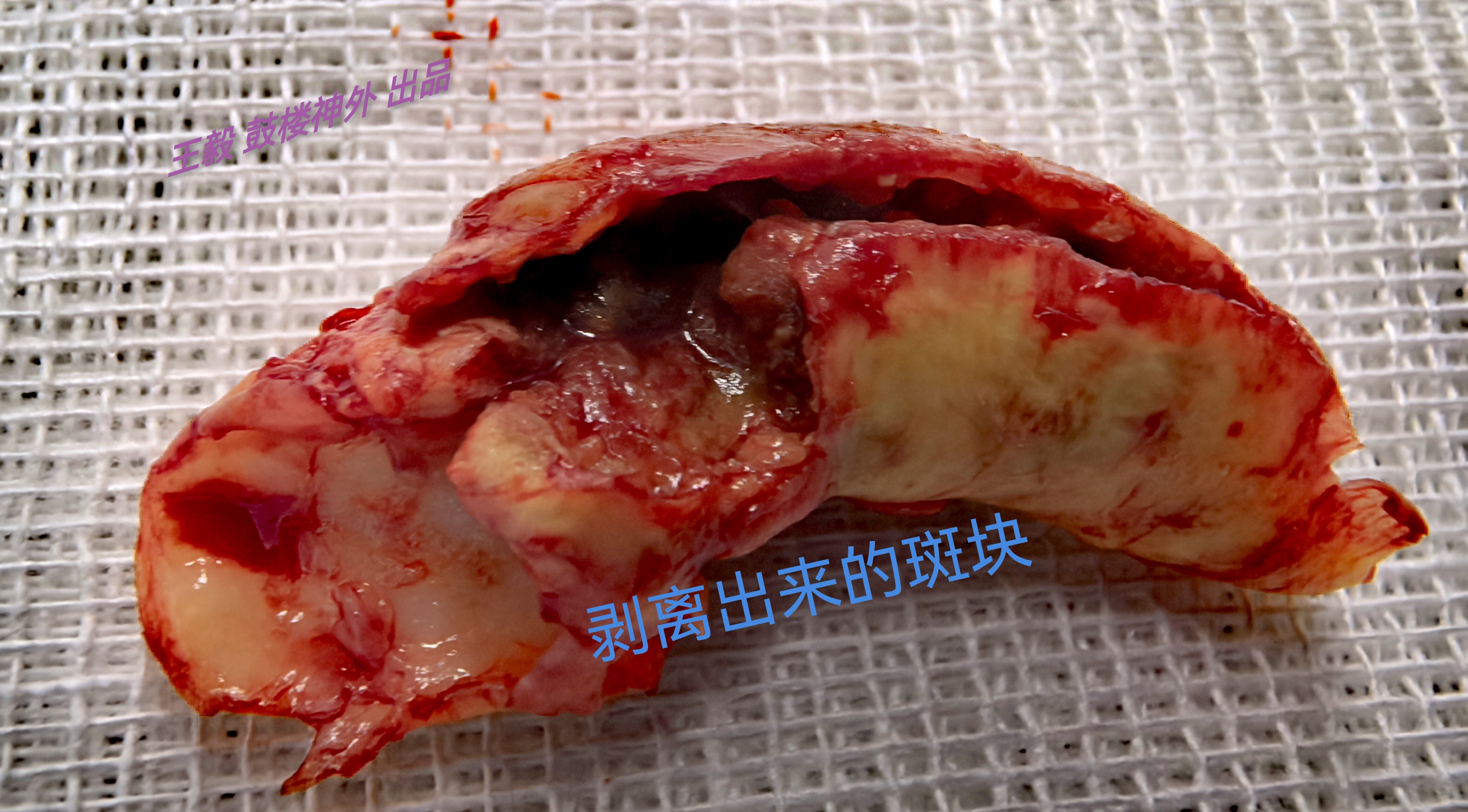 颈动脉斑块图片(颈动脉斑块图片位置示意图)