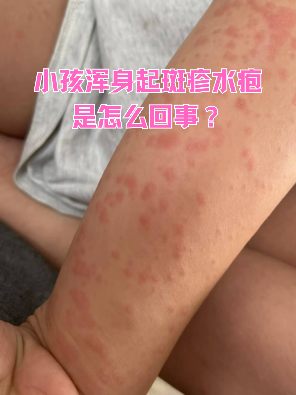 小儿水痘的症状和图片(小儿水痘的症状和图片大全)