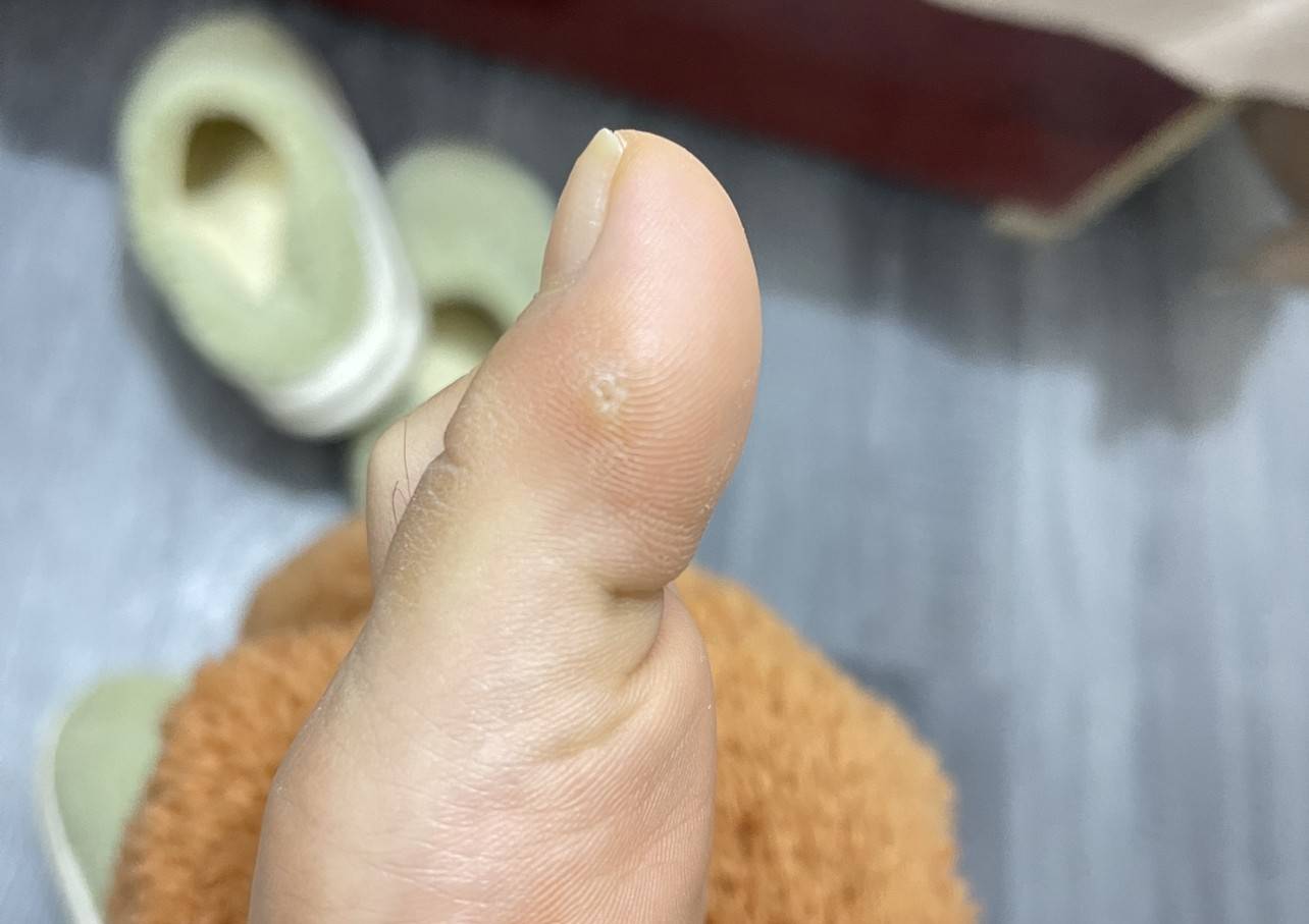 鸡眼图片初期症状(鸡眼的症状图片有哪些) 鸡眼图片初期症状(鸡眼的症状图片有哪些)